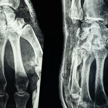 ​Kineski naučnici napravili „ostriga lepilo“ za kosti: Spoj za 2 minuta